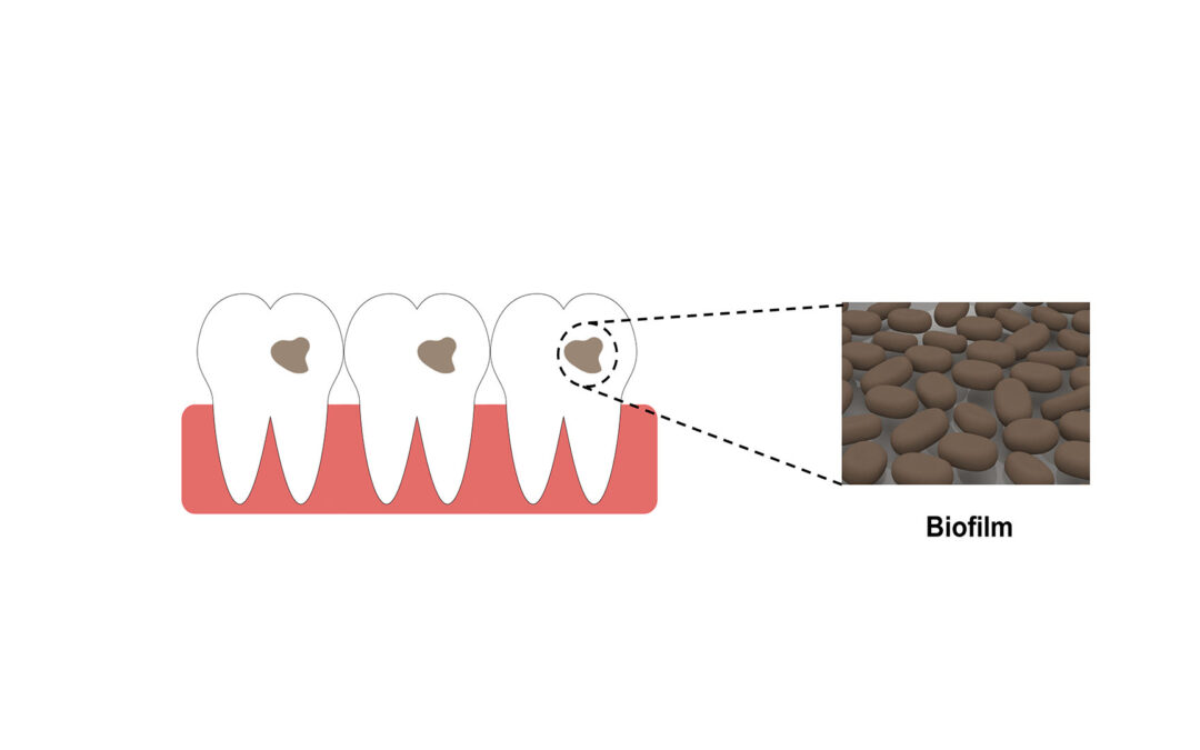 HKU Engineering and Dentistry collaborative study reveals Nanodiamonds to be an effective agent in tackling oral infections